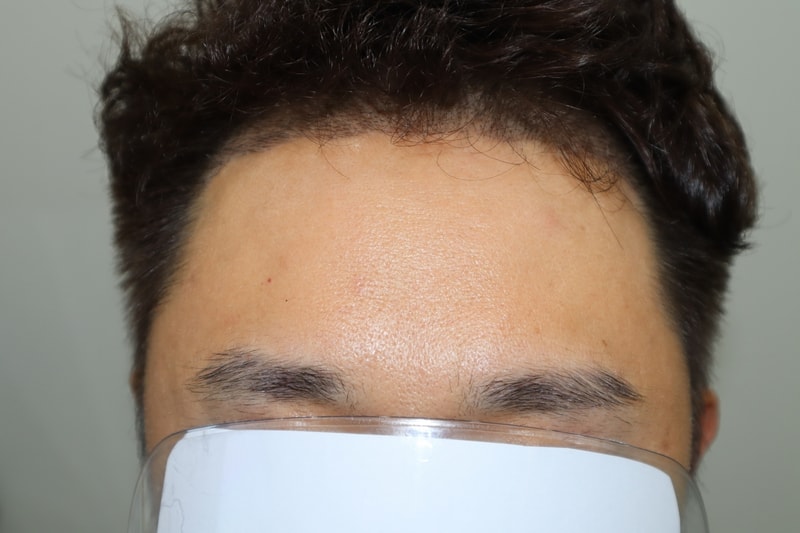 수술 후 2주차 정면.jpg