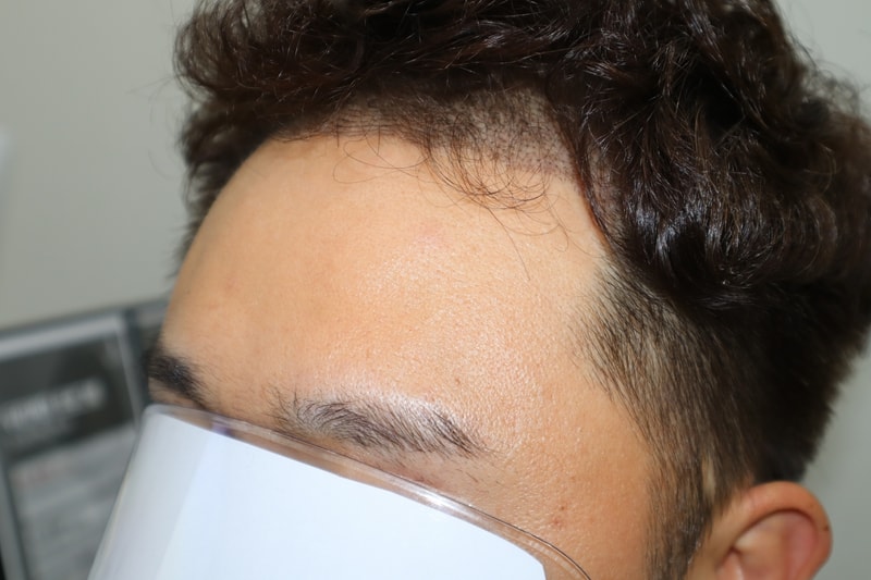 수술 후 2주차 우측.jpg