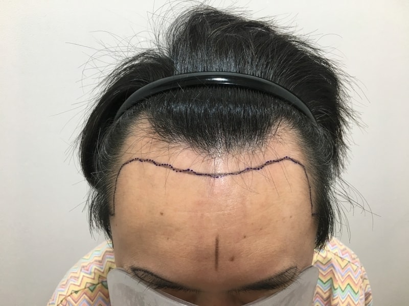 수술 후 100일 지났습니다. 경과보고입니다.