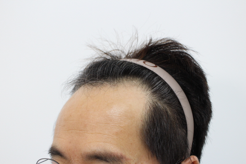 수술전.jpg