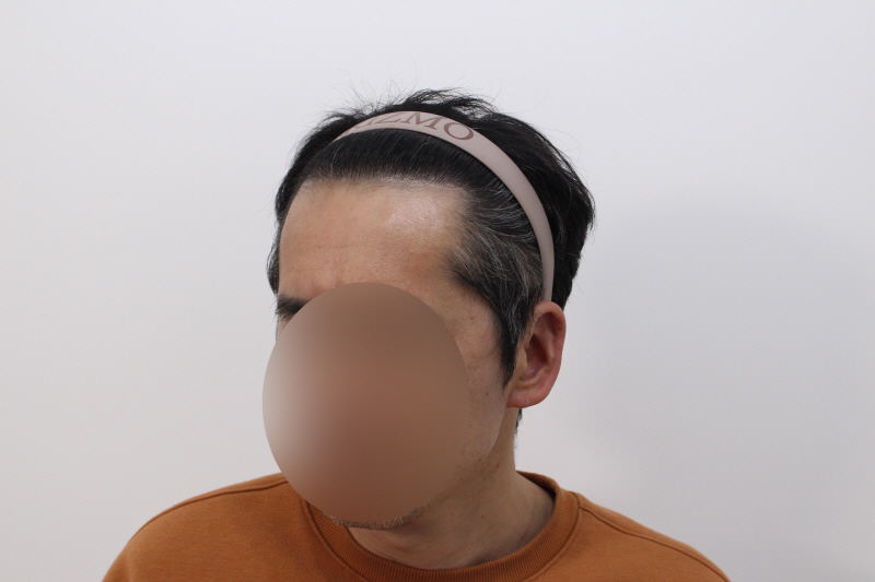 리즈모에서 수술후 8개월 모습.jpg