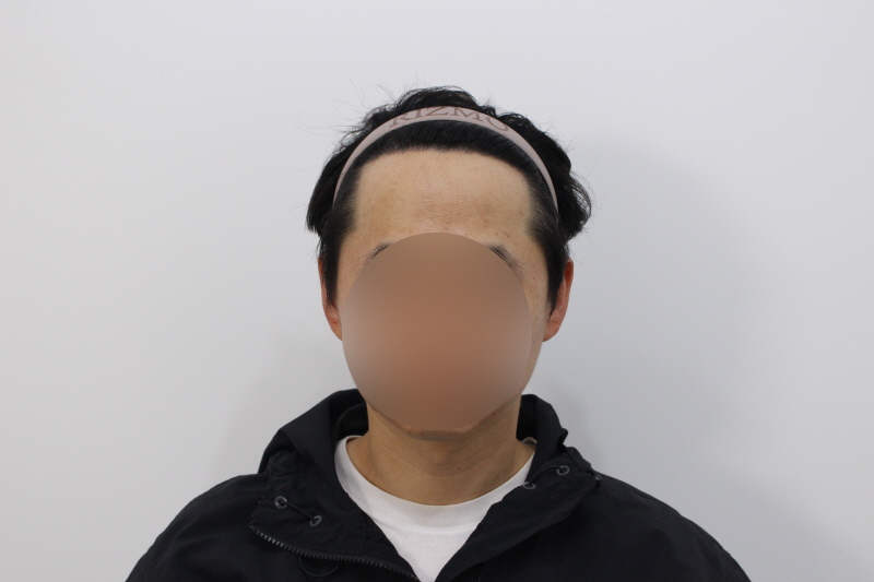 수술하고나서 12개월차.jpg