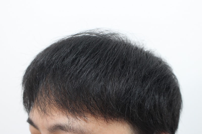 [크기변환]수술 후 11개월차 옆모습.jpg