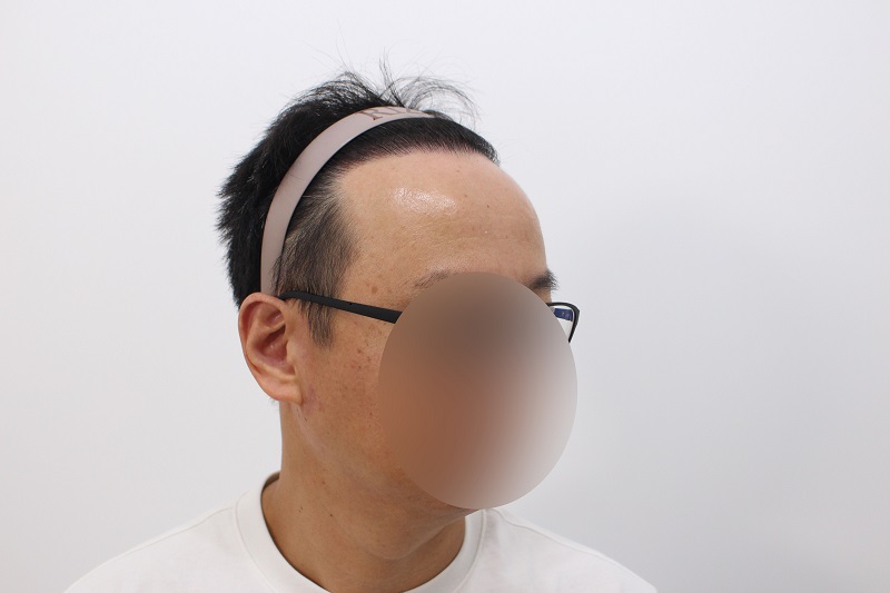 12.수술후 12개월 .jpg