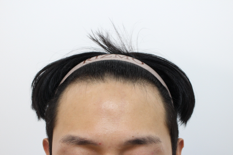 4.수술전.jpg