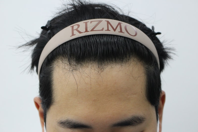 M자 모발이식 2000모 시술했습니다.