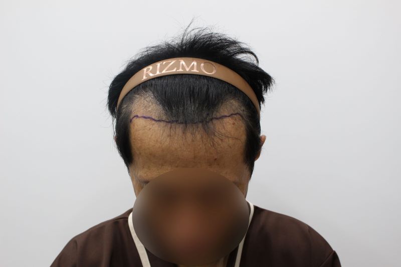 3. 대전모발이식센터 리즈모의원에서 원장님께서 섬세하고 신경써서 잘 디자인해주셨습니다. .jpg
