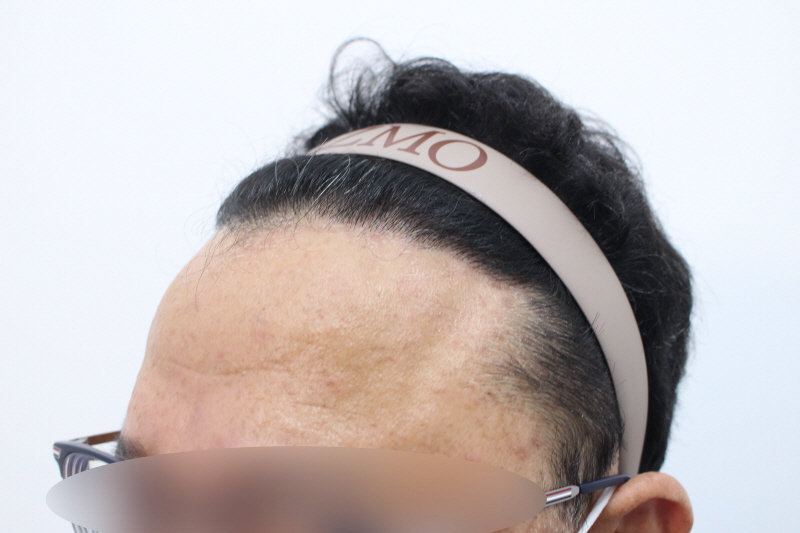 [크기변환]수술후 8개dd월차 옆모습.jpg