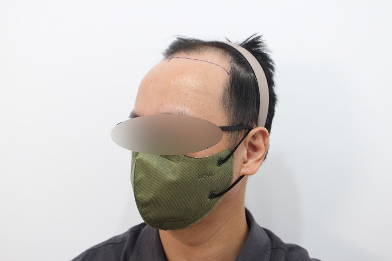 13. 수술전.jpg