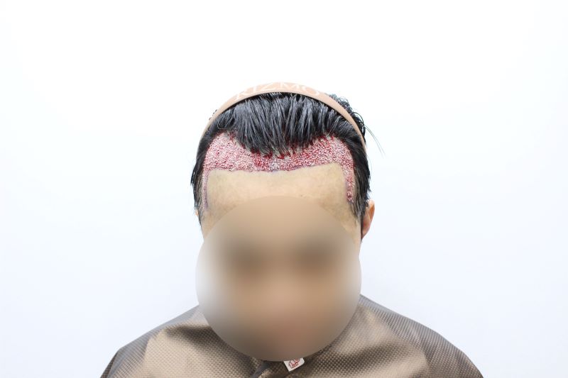 2 원하는라인으로 리즈모의원 원장님께서 고려해주셨습니다. 충분한 상담을 하고 수술당일 더 정밀하게 디자인해주셨습니다. .jpg