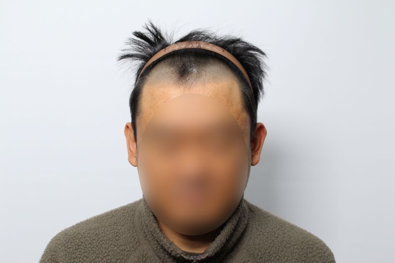 대전 리즈모 M자 헤어라인 4400모 모발이식 1일차 후기