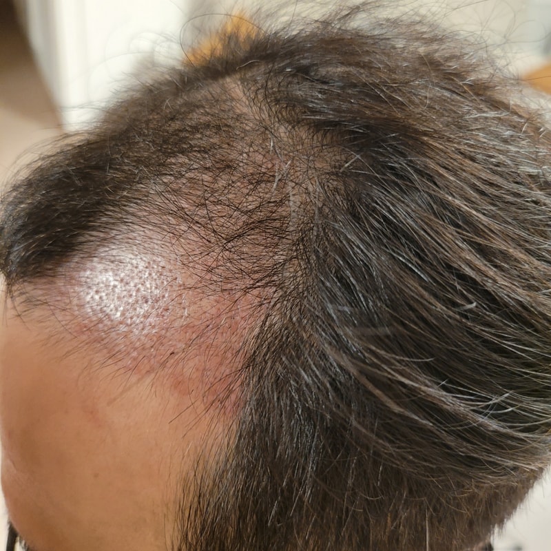 22.01.28 수술2개월암흑기 2.jpg