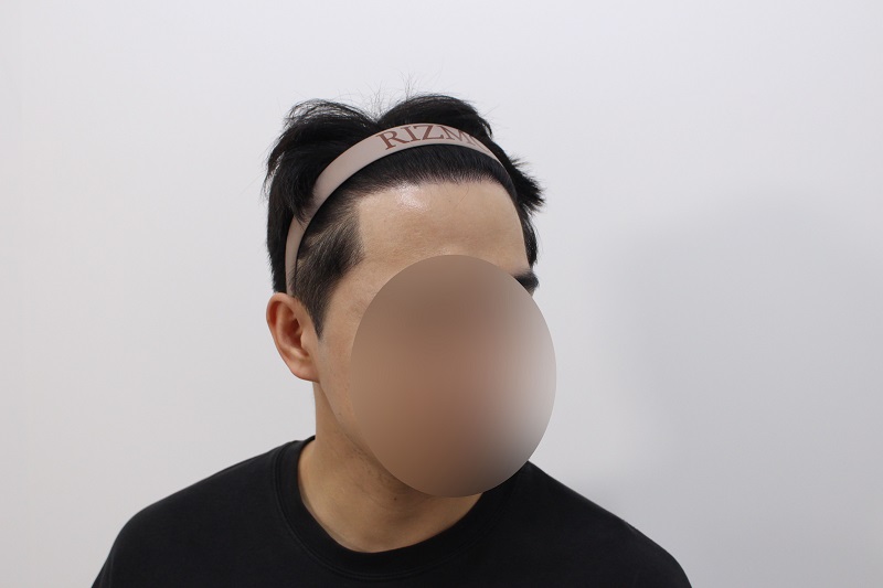 수술하고 12개월차입니다.jpg