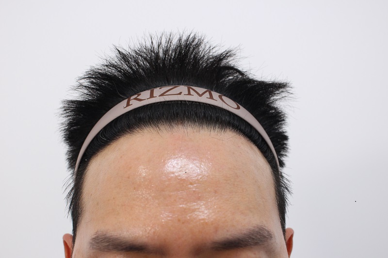3. 수술후 8개월.jpg