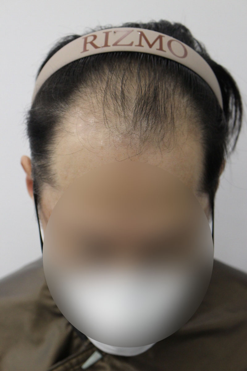 비절개 6000모 40대 남성 8개월차 후기입니다 ~