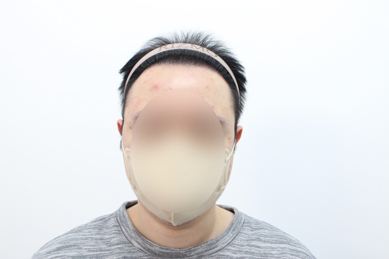 [크기변환]수술후 8개월d 2.jpg