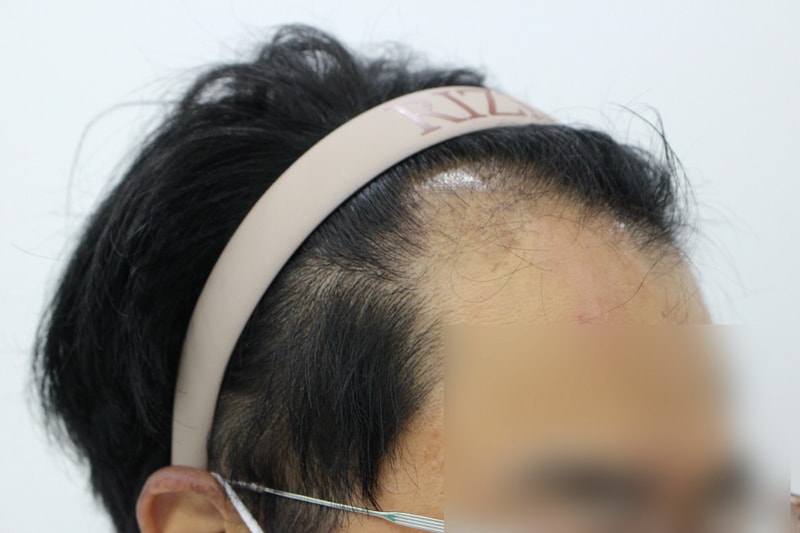 [크기변환]모발이식 전 옆.jpg