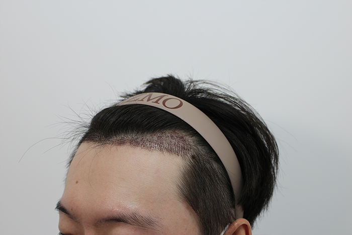 수술후-2주차.png
