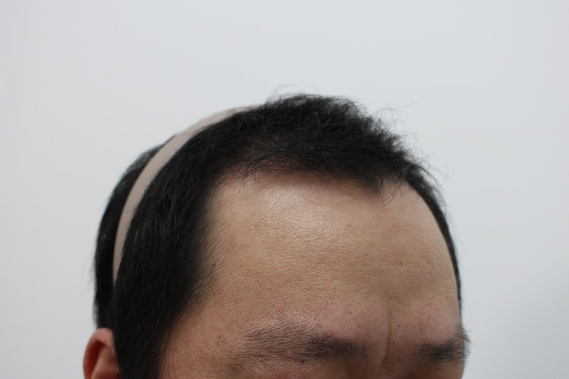 4-4개월경과_옆모습.jpg