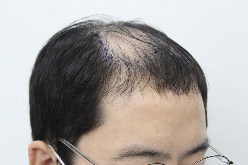 옆모습 수술전.jpg