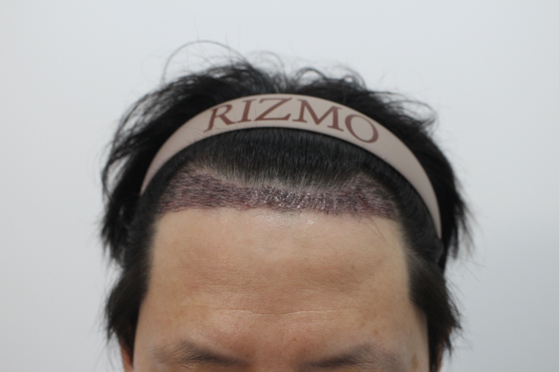 s수술후 2주차.jpg