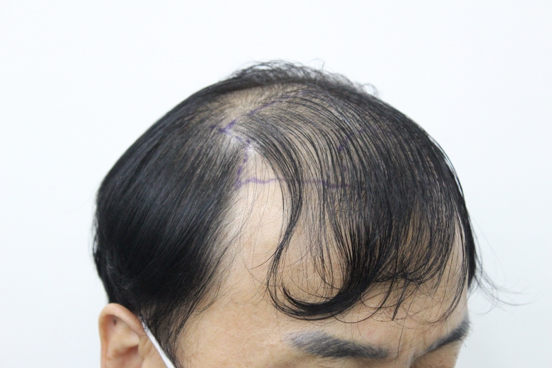 부산 리즈모에서 수술전부터 수술후 8개월까지의 변화모습