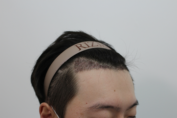 수술후-2주차_2.png