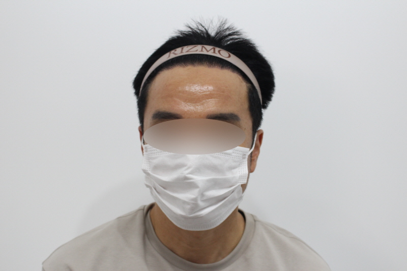 2[크기변환]부산 리즈모 수술후 8개월차 헤어라인d.jpg