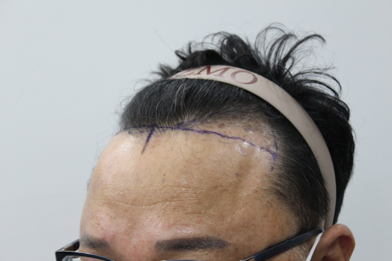 [크기변환]수술전 옆모습.jpg