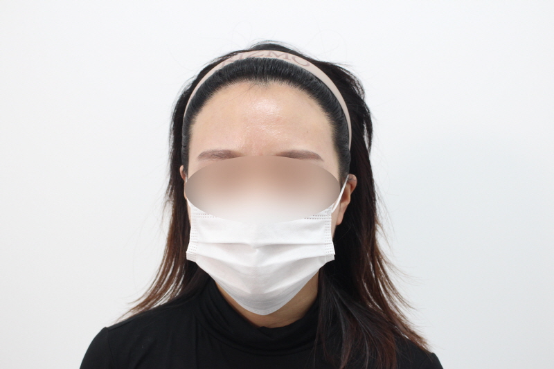 [크기변환]수술후 1년차 헤어라인 눈만 블러처리 타원형으로 해주세요ddd.jpg