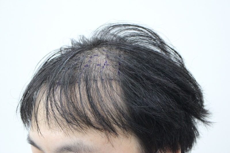 [크기변환]수술전 옆모습.jpg