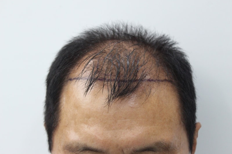 부산 리즈모 에서 70대 비절개 모발이식 1년 경과입니다