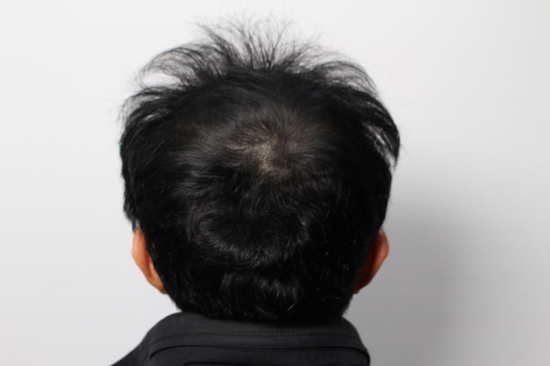 9.다음날 출근이여서 수술비는 2배내더라도 티않나는 무삭발로 해달라고 부탁드렸습니다. 감쪽같아서 좋았어요. .jpg