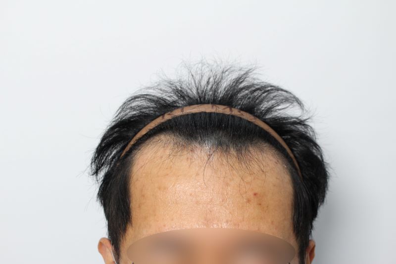 대전 리즈모 M자 헤어라인 1500모 모발이식 1일차 후기