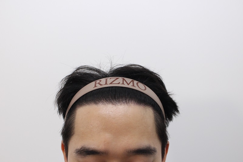수술후 12개월 지나서.jpg