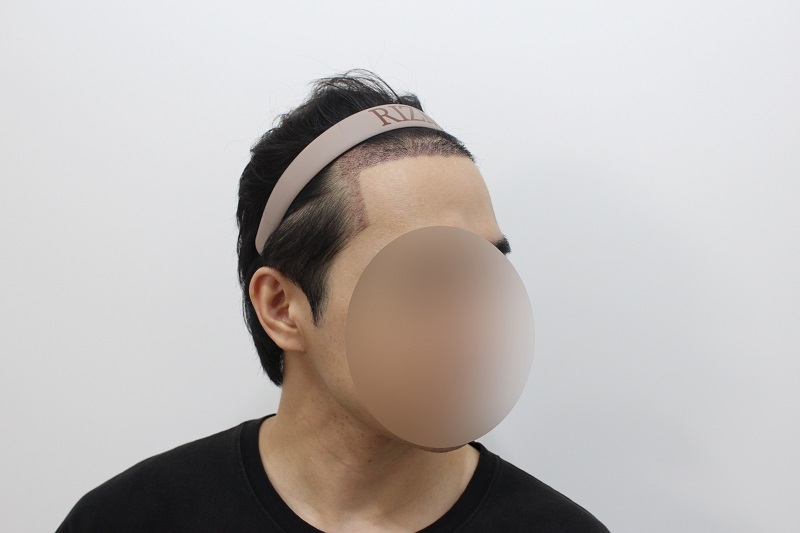 수술하고 2주 지나서.jpg