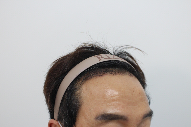 2[크기변환]수술후 120일차.jpg