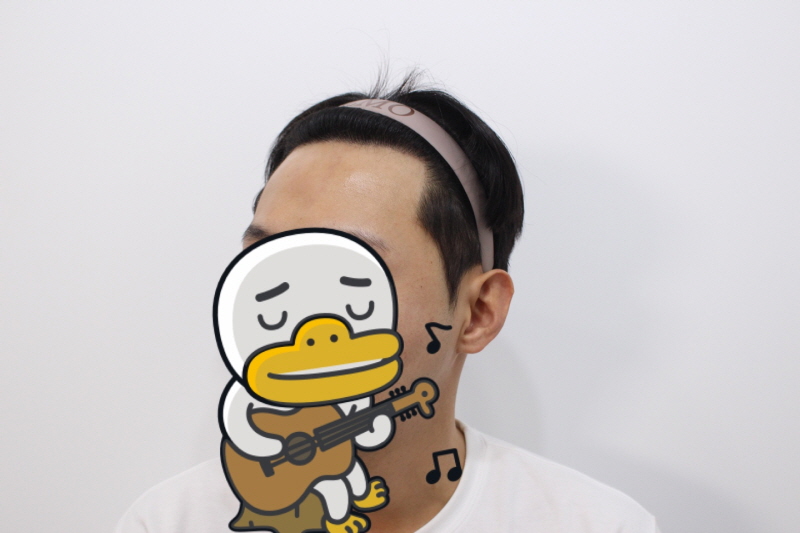 8. 수술후 10개월차.jpg
