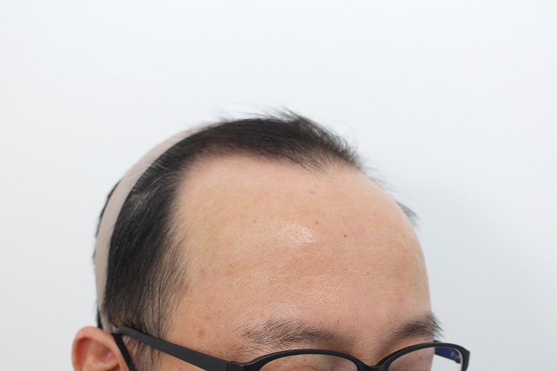 8. 수술전.jpg