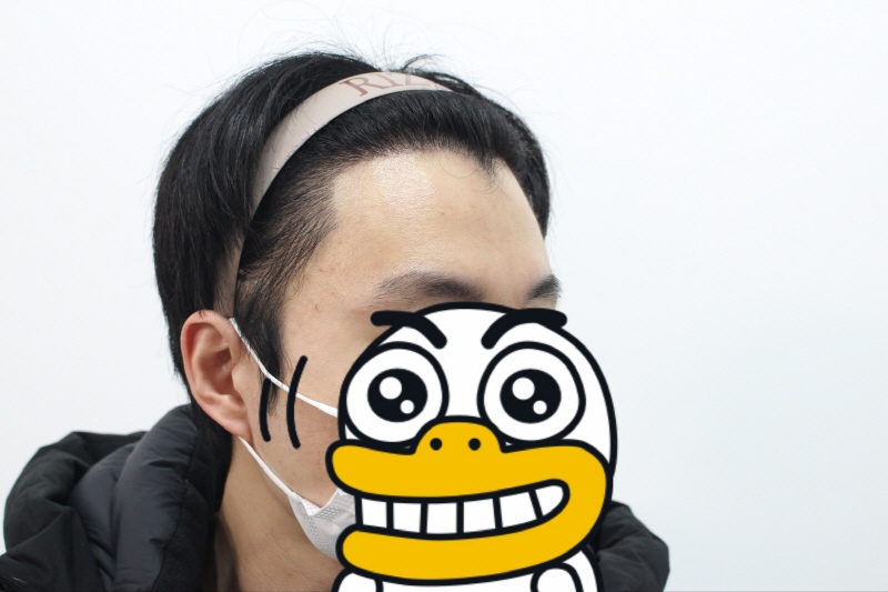 [크기변환]수술후 8개월차-옆모습.jpg
