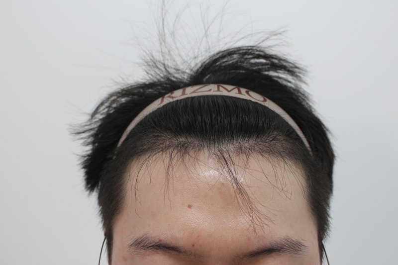 수술후 120일차.jpg
