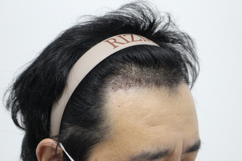 부산리즈모 비절개 1000모 1년차 후기 입니다