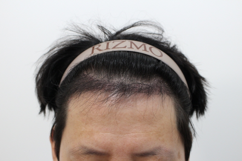 s수술후 4개월차 모발이 두피에서 나오기 시작합니다.jpg