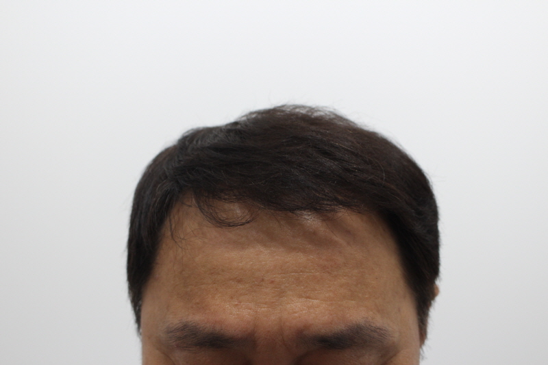 2[크기변환]부산 리즈모 수술후 8개월차.jpg