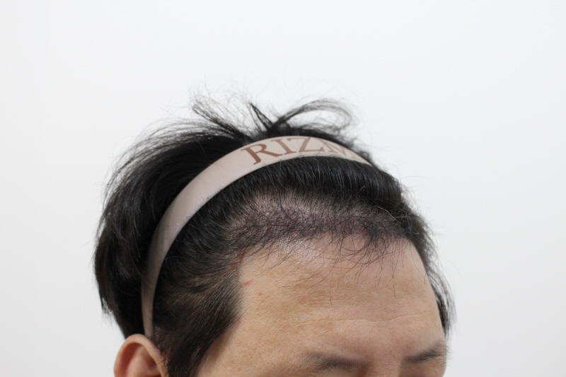 s부산 리즈모 수술후 120일차 모발이 정말 두피에서 나오기 시작합니다.jpg