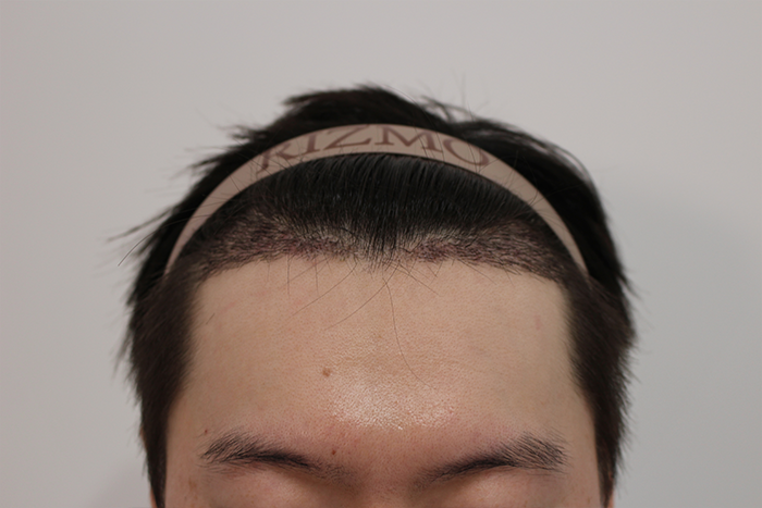 수술후-14일차.png