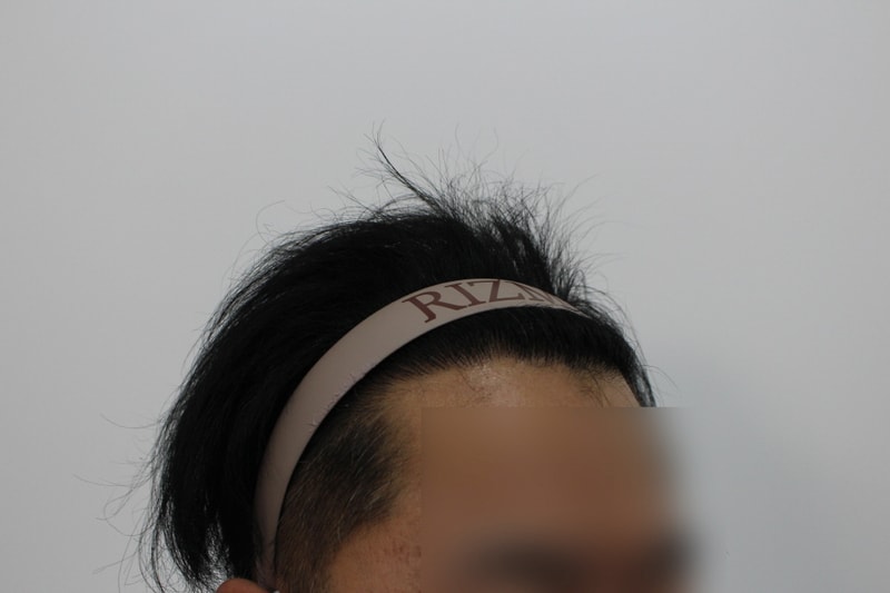 [크기변환]8개월 경과_ 옆.jpg