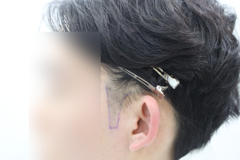 20대 초 구렛나루 8개월 경과 후기 !!