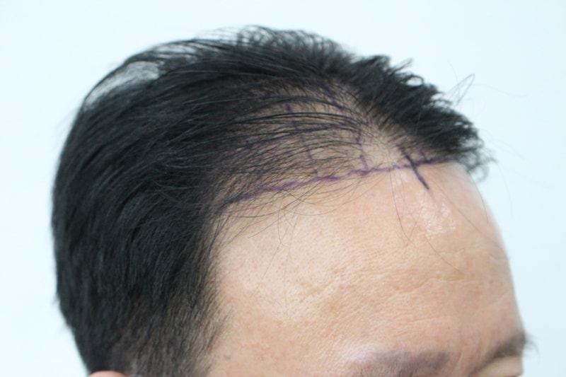 60대 모발이식 8개월차 후기입니다.