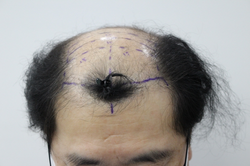 리즈모에서 5000모 50대 비절개 1년 후기입니다